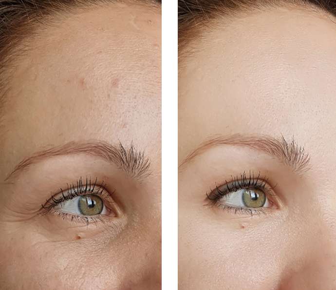 before and after botox image