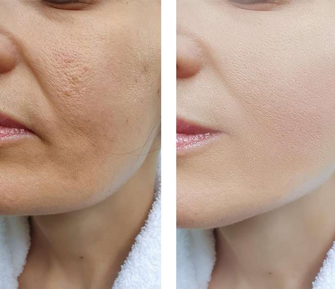 before and after botox image