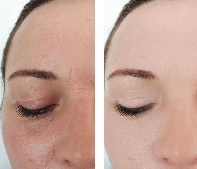 before and after botox image