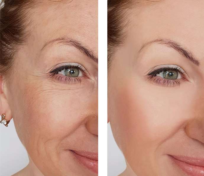 before and after botox image