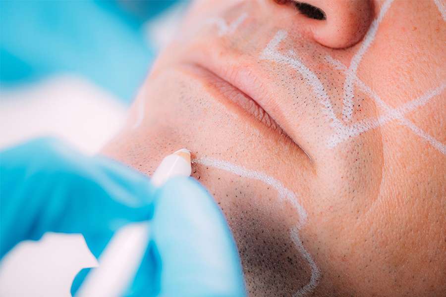 dermal fillers